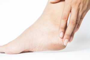 Woman cracked heels with white background, Foot healthy concept